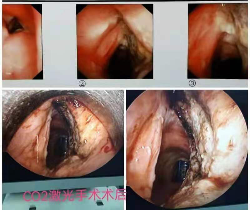 喉部鳞状细胞癌图片